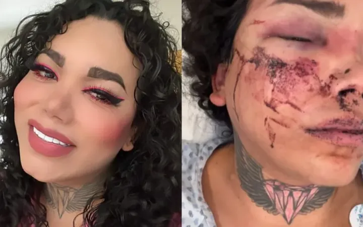 Paola Suarez a punto de perder el ojo