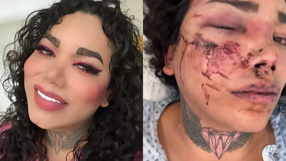 Paola Suarez a punto de perder el ojo